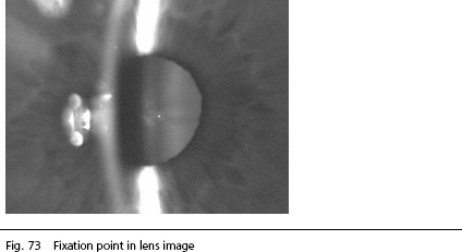 Cataract Surgery Arizona