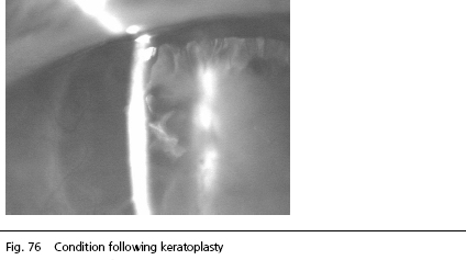 Cataract Surgery Arizona