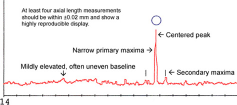 Moderate to Dense Cataract